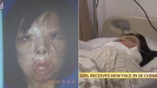 Illustration for article titled Burned Teen Grows New Face Parts on Her Chest (Warning: Graphic)